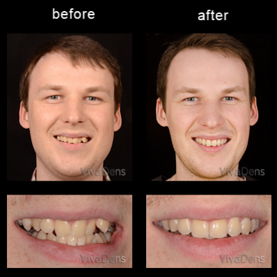 Short-Term Ortho Six Month Smiles